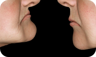 Modificări ale formei feței