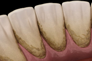 DentOne